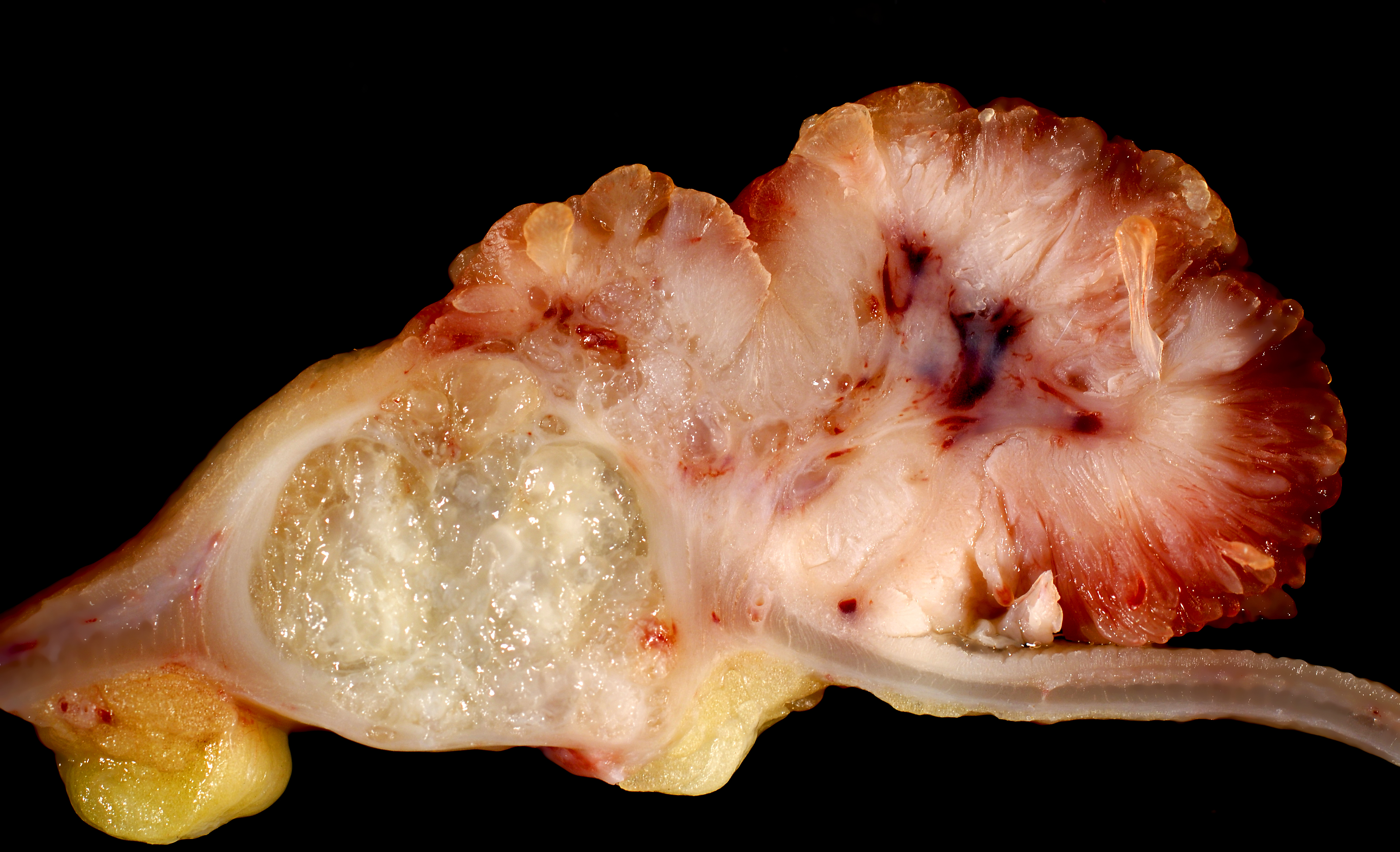 Muzinöses Adenokarzinom des Kolons
Muzinöses Adenokarzinom (links) entstanden aus einem tubulovillösen Adenom (rechts)